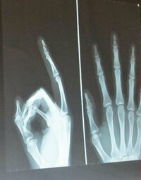 7月12日に中指の末節骨骨折をしました 治療法や完治までの期間について Yahoo 知恵袋