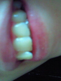 矯正の後戻りについて質問です 私は７年くらい前に矯正したのですが リテ Yahoo 知恵袋