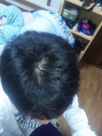 これは薄毛ですか ７月くらいからもみあげ 襟足の毛を引っ張ると２ ３本 Yahoo 知恵袋