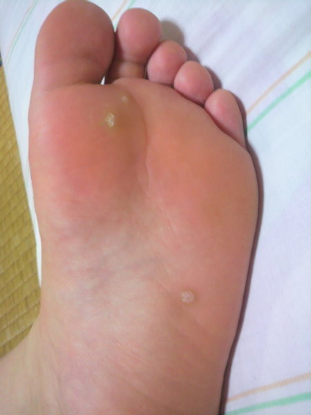 水虫 すべての質問 Yahoo 知恵袋