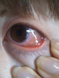 被災地からです 医師にかかろうか悩んでいます 目がかゆく 内まぶたが透 Yahoo 知恵袋