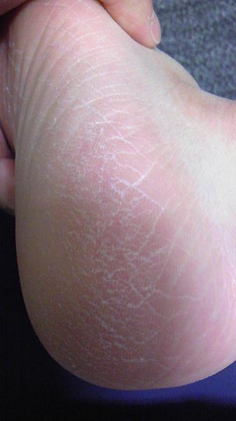 水虫 解決済みの質問 Yahoo 知恵袋