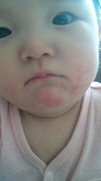 アレルギーですか ４ヶ月の娘 混合で育てていた娘が１ヶ月くらいまえから Yahoo 知恵袋