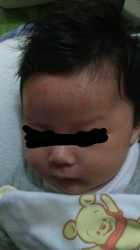 ミルクアレルギーの症状でしょうか 生後２ヶ月目の子供で完ﾐで育ててます Yahoo 知恵袋