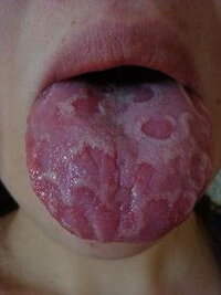 地図状舌になりました 原因不明の治療法も確立してないとのことですが 地図状舌に Yahoo 知恵袋