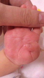 手相 ダウン症 に関するq A Yahoo 知恵袋