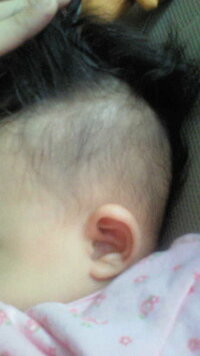 赤ちゃんの髪型 サイドが伸びない５ヶ月の赤ちゃんです 産まれたと Yahoo 知恵袋