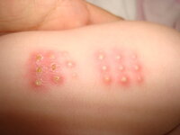 もうすぐ４ヶ月になる息子がbcgを昨日受けたのですが それか Yahoo 知恵袋