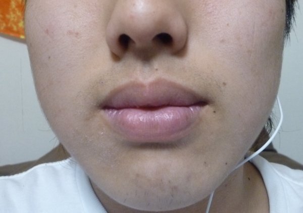 たらこ唇について - 自分は１６歳の男です自分はたらこ唇で悩んでい