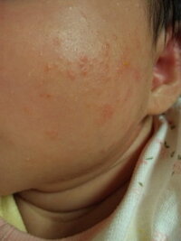 生後26日の赤ちゃんなんですが 10日ぐらい前から顔全体に湿 Yahoo 知恵袋