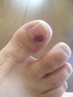 茶色 足 親指 爪 変色