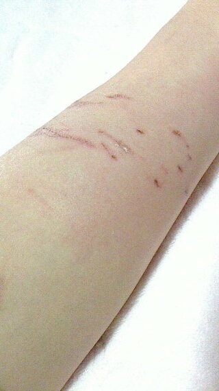 猫に噛まれたのですが病院に行くべきでしょうか 噛まれた腕の画像 Yahoo 知恵袋