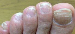 円形の バングラデシュ 中絶 足 爪 横筋 4 Ad Jp