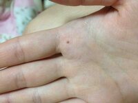 女です 右手の人差し指の下にほくろがあります 昔はなかったので Yahoo 知恵袋