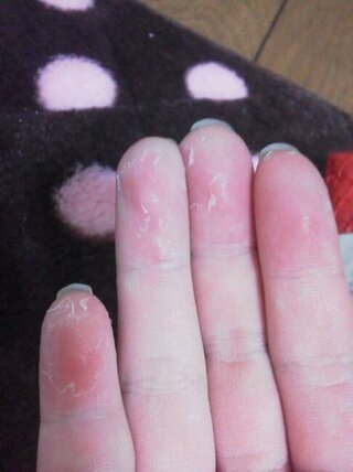 むける 皮 手のひら の
