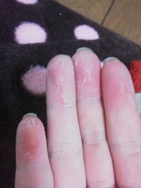 むける 手のひら 原因 皮 手や指の皮がボロボロむける５つ原因と対策！病気の可能性もあり？