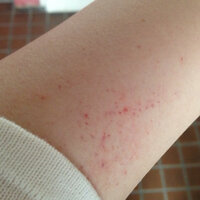 腕にこんな湿疹ができました 痛くも痒くもないですが 何でしょうか 放置し Yahoo 知恵袋