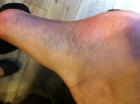 下肢静脈瘤にお詳しい方教えて下さい 足のむくみがひどく 辛いです 私の足 Yahoo 知恵袋