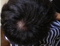 これはハゲでしょうか 現在25歳なのですが頭頂部がはげてるように思います Yahoo 知恵袋