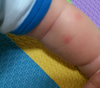 赤ちゃんのぶつぶつについて 5ヶ月の赤ちゃんがいます ちょっと前から画像 Yahoo 知恵袋