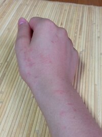 最近犬に噛まれるとミミズ腫れがすぐできます これはアレルギーみたいなものにな Yahoo 知恵袋