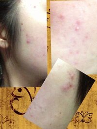 頬のにきびが治りません 人 高校生女子です 画像は汚いですが こん Yahoo 知恵袋