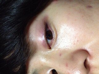 この症状は眼瞼炎でしょうか 最近化粧水をグリセリン化粧水 Yahoo 知恵袋