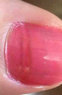 足の親指の爪がこのように段差ができてしまいます 色も茶色っぽくなってしまいます Yahoo 知恵袋