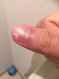 親指の爪が割れてから伸ばしても割れ 伸ばしても割れを繰り返しています ど Yahoo 知恵袋
