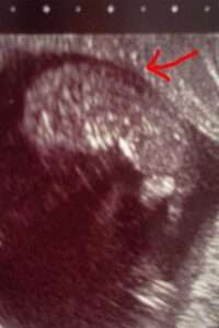 胎児浮腫と羊膜について 妊娠10w3dです 胎児についての勉強 Yahoo 知恵袋