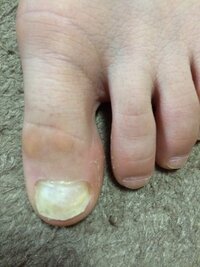爪が浮く 剥がれる 画像あり小学四年生です 左足親指の爪が剥がれそ Yahoo 知恵袋
