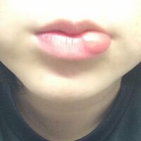 唇 が 腫れる 下 ～舌が腫れる～【舌が痛い.com】症状について