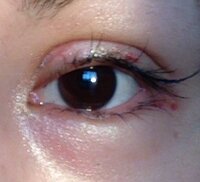 二重瞼の整形 全切開をしました 経験者の方 アドバイスください Yahoo 知恵袋