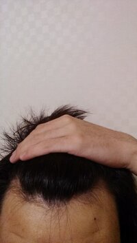 頭がはげてきました 原因は極度のストレスと生活リズムの乱れ 眼精疲労だと Yahoo 知恵袋