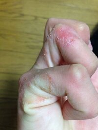 男子高校生です 最近手荒れ がものすごく酷いです オロナイン塗って Yahoo 知恵袋