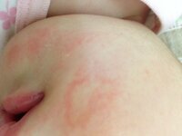 画像あり生後2カ月の赤ちゃんの頬に丸い湿疹ができました 直径1cmほど Yahoo 知恵袋