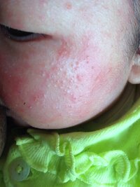 乳児性湿疹と写真撮影 お宮参りの写真を撮ろうと予約をしていたのですが Yahoo 知恵袋