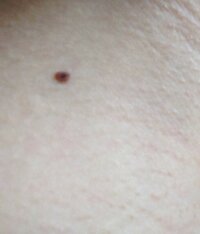 昨日気づいたほくろです すこしボコっとしていて真ん中が黒いので Yahoo 知恵袋
