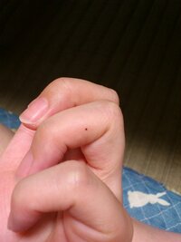 手のひらの指に突然ほくろができました 12月上旬に気づいた際はただの小 Yahoo 知恵袋