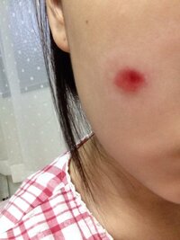 傷についてまわりのあかいのがきえません 最初キズパワーパッドを Yahoo 知恵袋