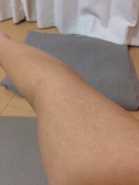 美白について 腕の日焼け シミ がひどいです まだら模様になっ Yahoo 知恵袋