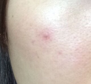 70以上 顔の赤い斑点 赤ちゃん 顔の赤い斑点