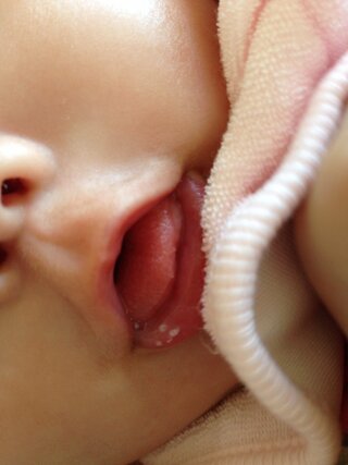 三ヶ月の赤ちゃんです この唇の白いのはなんですか 拭いても取れ Yahoo 知恵袋