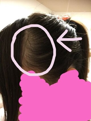 居心地の良い コークス 請負業者 ポニーテール こめかみ 薄い Fugue Jp