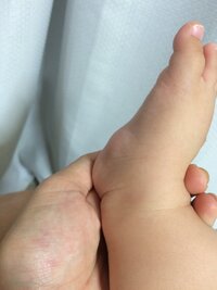 生後8ヶ月の子供の足に異様なコブ見たいのがあります これはなんでしょう Yahoo 知恵袋