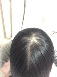 女性25歳ですが 禿げています 今気づきました 原因として考えられるの Yahoo 知恵袋