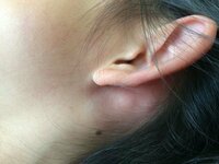 耳 の 後ろ 腫れ コロナ