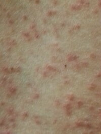 五日くらい前から背中に赤い湿疹が出来てしまいました 皮膚科に行ったのです Yahoo 知恵袋