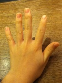 私は手の指の形が変で悩んでいます 指が短いんですが手が15cmしかなくて Yahoo 知恵袋