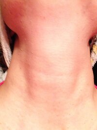 最近 首が太くなった様な気がしますが バセドウ病でしょうか Yahoo 知恵袋